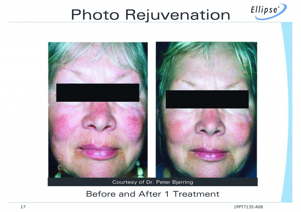 IPL/Laser Skin Rejuvenation Laser Hair Removal & Skincare